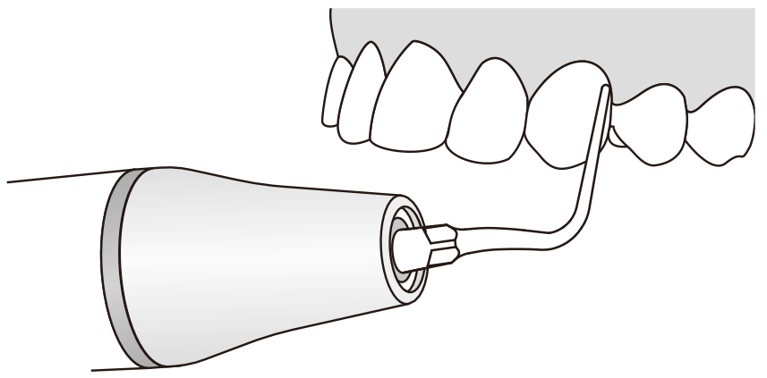 Сфера применения наконечника для скалера